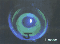 Fluorescein pattern of a loose ortho-k fit